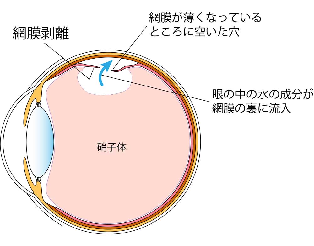網膜 剥離 手術 後 仕事