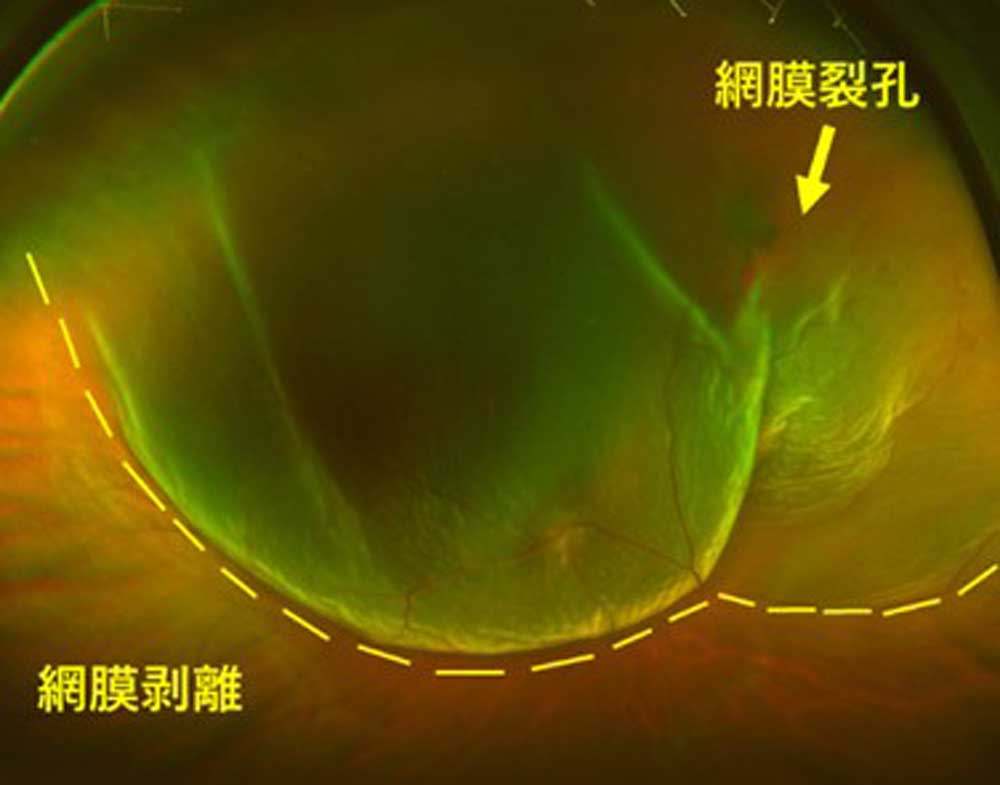 網膜剥離 強膜バックリング 小沢眼科内科病院