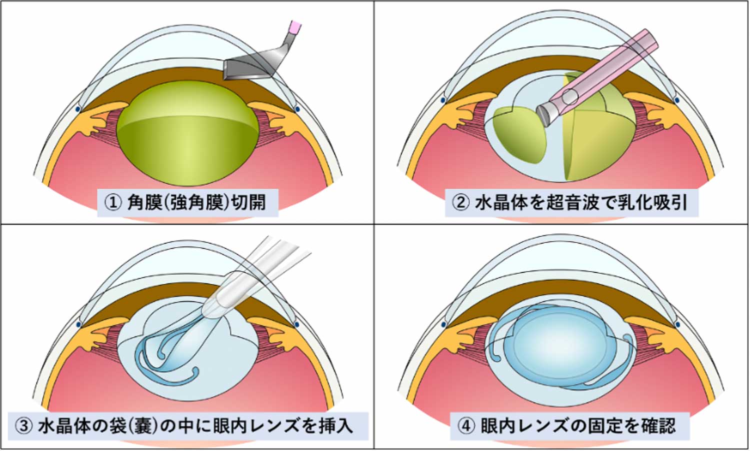 網膜 剥離 について 正しい の は どれ か