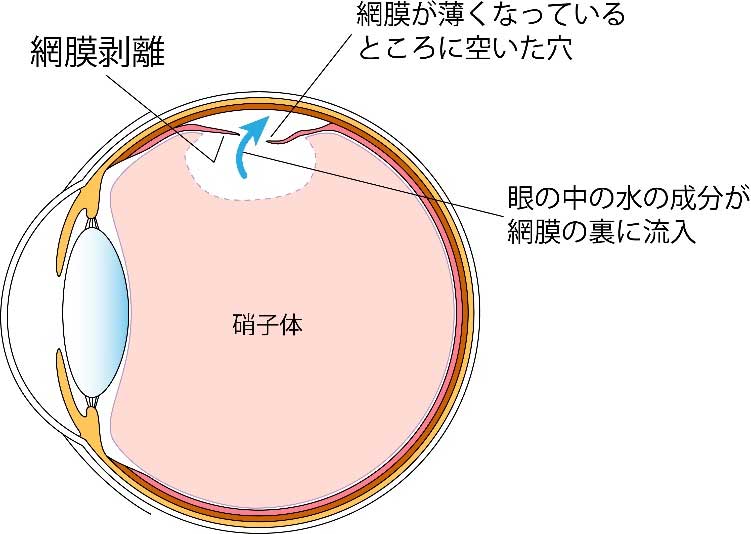 網膜剥離 小沢眼科内科病院